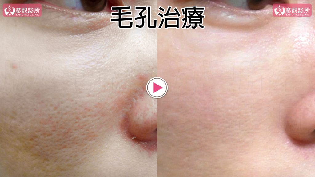 醫美雷射介紹 銣雅鉻雷射 飛梭雷射 毛孔凹洞凹疤雷射 彥靚診所 醫美 減重