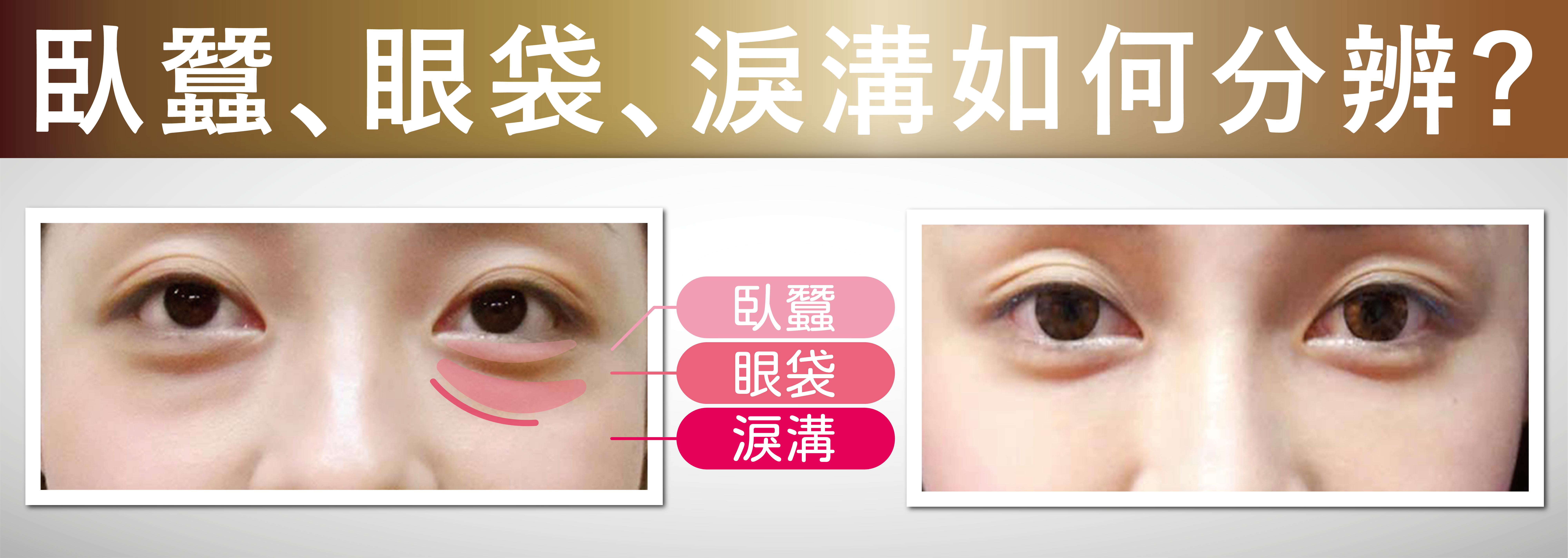 淚溝怎麼改善?先辨黑眼圈成因,再選適合的療程 6 臥蠶、眼袋與淚溝部位對照