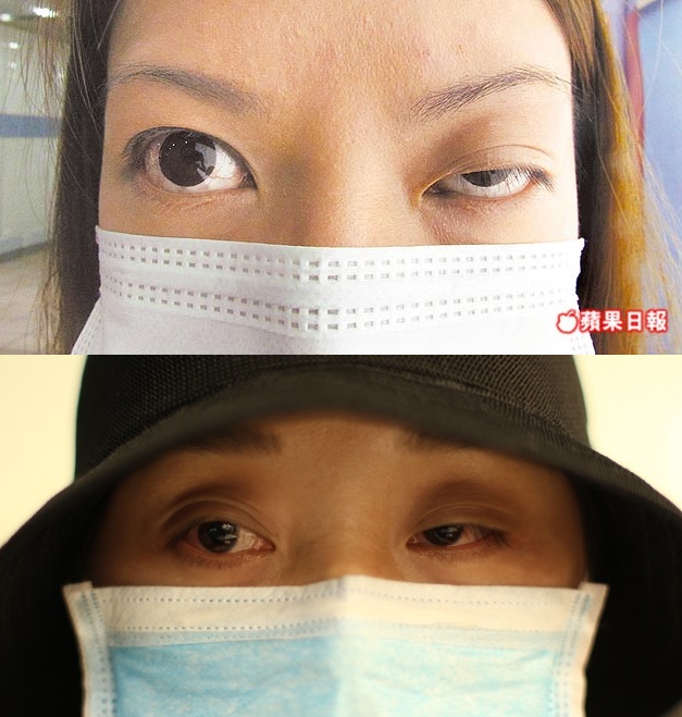 肉毒桿菌效果 價格費用 副作用 大揭密 彥靚診所 醫美 減重