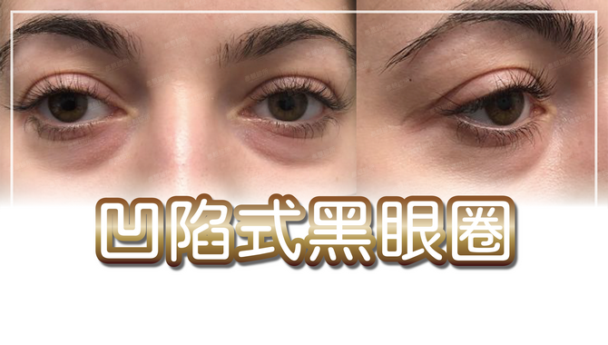 凹陷型黑眼圈可以靠醫美改善，了解原因後再針對淚溝注射大分子玻尿酸，改善淚溝同時拉提眼袋，效果持久推薦