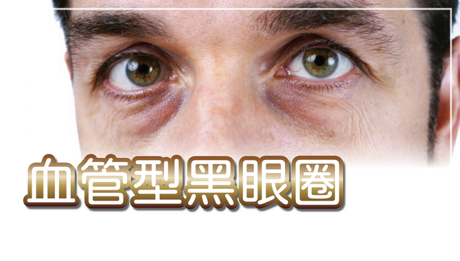 血管型型黑眼圈可以靠醫美改善，了解原因後再針對淚溝注射大分子玻尿酸，效果持久推薦