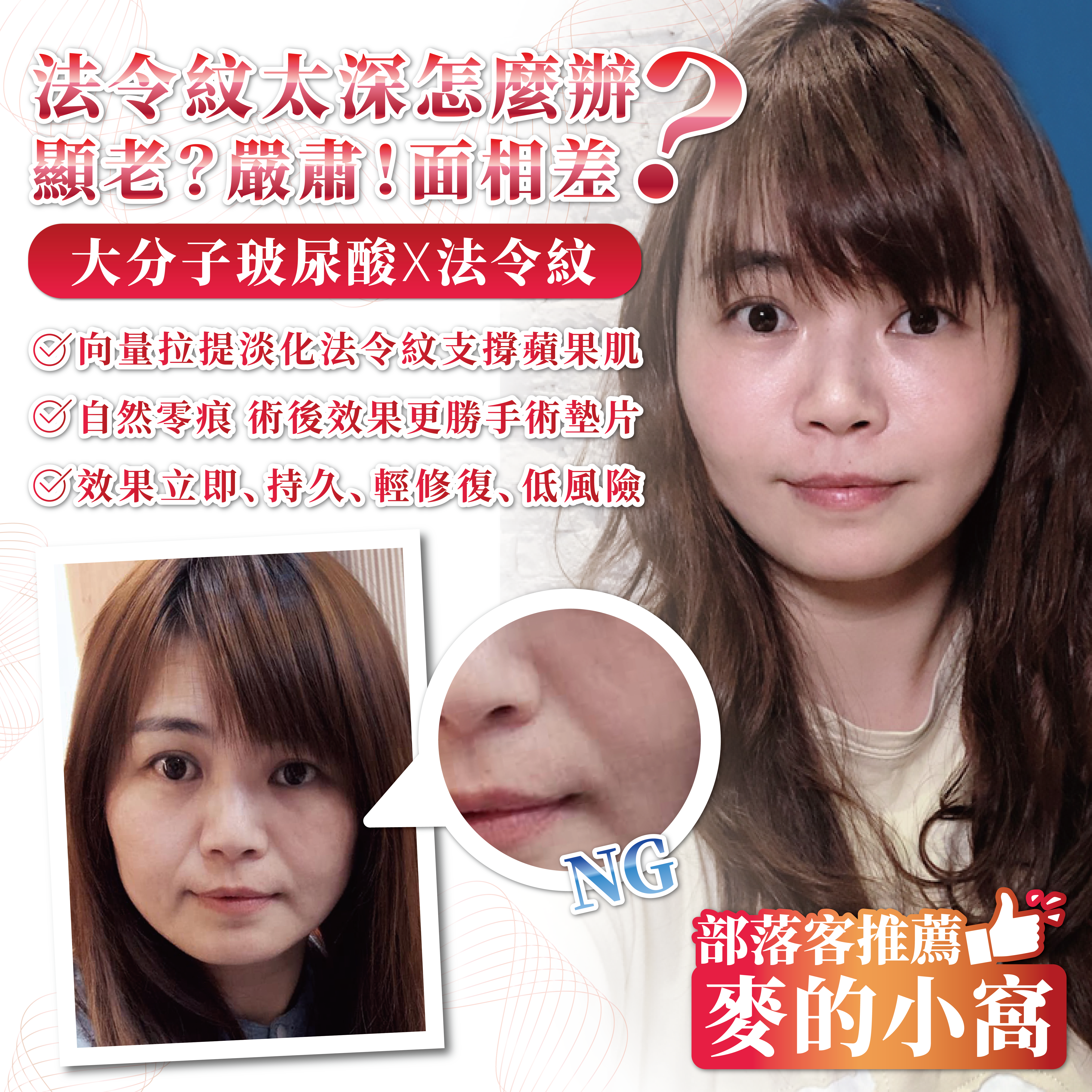 法令紋很深怎麼辦 醫美專家推薦5大方式 細說優缺點讓你知 彥靚診所 醫美 減重