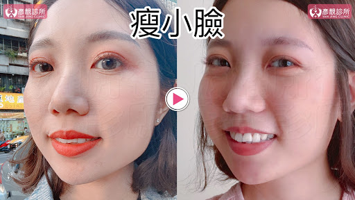 彥靚診所推薦|肉毒瘦小臉 打造上鏡V字臉效果 消除咀嚼肌還原緊緻輪廓線 11 肉毒桿菌 肉毒 v臉 瘦小臉 消脂針 除皺 價格費用 消除改善 心得 分享 禁忌 副作用併發症後遺症 失敗 推薦 彥靚 診所 醫美 醫生 醫師 效果 風險 治療 文 評價 台北 桃園 新竹 dcard ptt 20210612 10