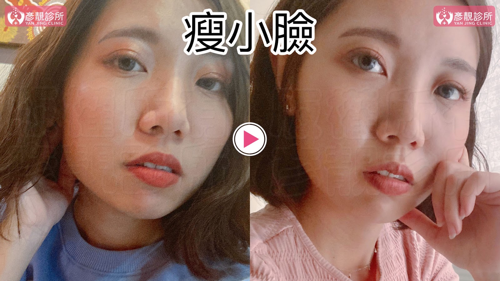 彥靚診所推薦|肉毒瘦小臉 打造上鏡V字臉效果 消除咀嚼肌還原緊緻輪廓線 12 肉毒桿菌 肉毒 v臉 瘦小臉 消脂針 除皺 價格費用 消除改善 心得 分享 禁忌 副作用併發症後遺症 失敗 推薦 彥靚 診所 醫美 醫生 醫師 效果 風險 治療 文 評價 台北 桃園 新竹 dcard ptt 20210612 11