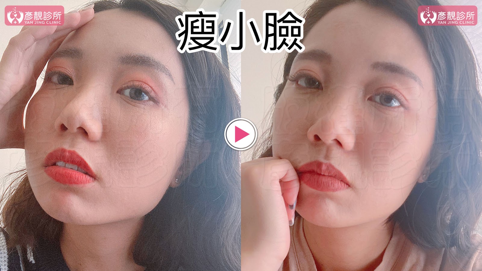 彥靚診所推薦|肉毒瘦小臉 打造上鏡V字臉效果 消除咀嚼肌還原緊緻輪廓線 13 肉毒桿菌 肉毒 v臉 瘦小臉 消脂針 除皺 價格費用 消除改善 心得 分享 禁忌 副作用併發症後遺症 失敗 推薦 彥靚 診所 醫美 醫生 醫師 效果 風險 治療 文 評價 台北 桃園 新竹 dcard ptt 20210612 12