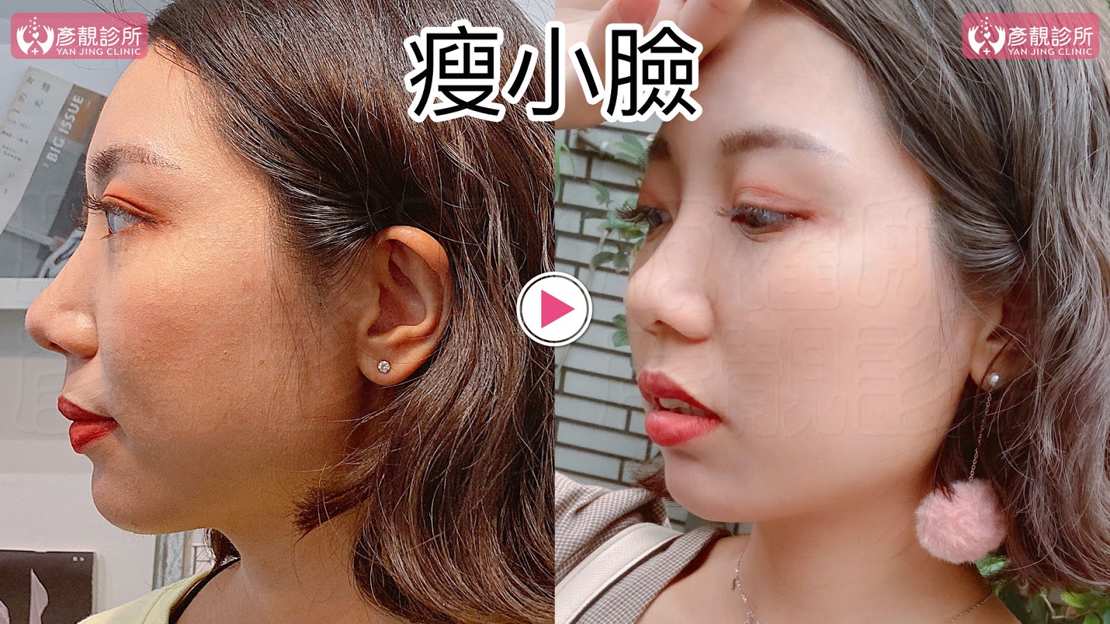 彥靚診所推薦|肉毒瘦小臉 打造上鏡V字臉效果 消除咀嚼肌還原緊緻輪廓線 14 肉毒桿菌 肉毒 v臉 瘦小臉 消脂針 除皺 價格費用 消除改善 心得 分享 禁忌 副作用併發症後遺症 失敗 推薦 彥靚 診所 醫美 醫生 醫師 效果 風險 治療 文 評價 台北 桃園 新竹 dcard ptt 20210612 13