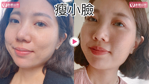 彥靚診所推薦|肉毒瘦小臉 打造上鏡V字臉效果 消除咀嚼肌還原緊緻輪廓線 15 肉毒桿菌 肉毒 v臉 瘦小臉 消脂針 除皺 價格費用 消除改善 心得 分享 禁忌 副作用併發症後遺症 失敗 推薦 彥靚 診所 醫美 醫生 醫師 效果 風險 治療 文 評價 台北 桃園 新竹 dcard ptt 20210612 14