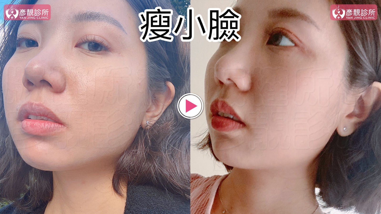 彥靚診所推薦|肉毒瘦小臉 打造上鏡V字臉效果 消除咀嚼肌還原緊緻輪廓線 16 肉毒桿菌 肉毒 v臉 瘦小臉 消脂針 除皺 價格費用 消除改善 心得 分享 禁忌 副作用併發症後遺症 失敗 推薦 彥靚 診所 醫美 醫生 醫師 效果 風險 治療 文 評價 台北 桃園 新竹 dcard ptt 20210612 15