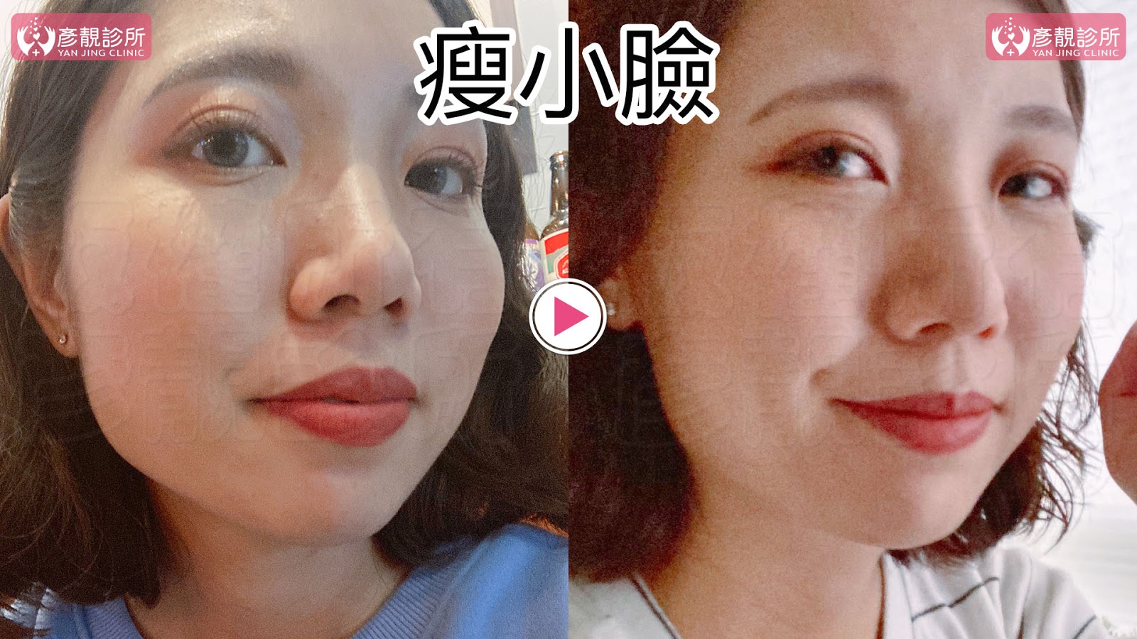 彥靚診所推薦|肉毒瘦小臉 打造上鏡V字臉效果 消除咀嚼肌還原緊緻輪廓線 17 肉毒桿菌 肉毒 v臉 瘦小臉 消脂針 除皺 價格費用 消除改善 心得 分享 禁忌 副作用併發症後遺症 失敗 推薦 彥靚 診所 醫美 醫生 醫師 效果 風險 治療 文 評價 台北 桃園 新竹 dcard ptt 20210612 16