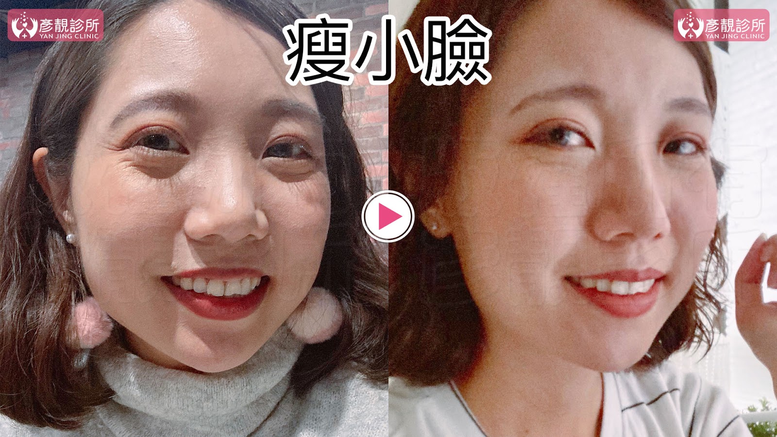 彥靚診所推薦|肉毒瘦小臉 打造上鏡V字臉效果 消除咀嚼肌還原緊緻輪廓線 18 肉毒桿菌 肉毒 v臉 瘦小臉 消脂針 除皺 價格費用 消除改善 心得 分享 禁忌 副作用併發症後遺症 失敗 推薦 彥靚 診所 醫美 醫生 醫師 效果 風險 治療 文 評價 台北 桃園 新竹 dcard ptt 20210612 17