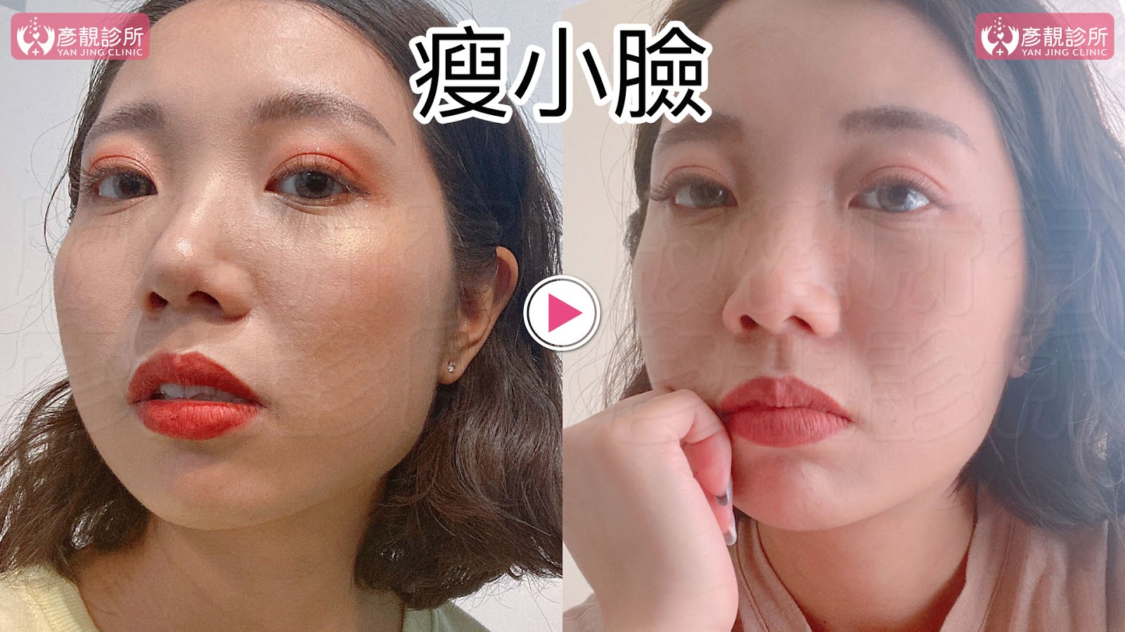 彥靚診所推薦|肉毒瘦小臉 打造上鏡V字臉效果 消除咀嚼肌還原緊緻輪廓線 10 肉毒桿菌 肉毒 v臉 瘦小臉 消脂針 除皺 價格費用 消除改善 心得 分享 禁忌 副作用併發症後遺症 失敗 推薦 彥靚 診所 醫美 醫生 醫師 效果 風險 治療 文 評價 台北 桃園 新竹 dcard ptt 20210612 9