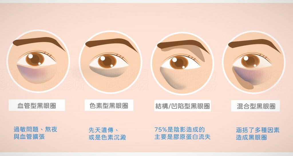 黑眼圈-血管型黑眼圈、色素型黑眼圈、凹陷型黑眼圈都可以藉由玻尿酸改善