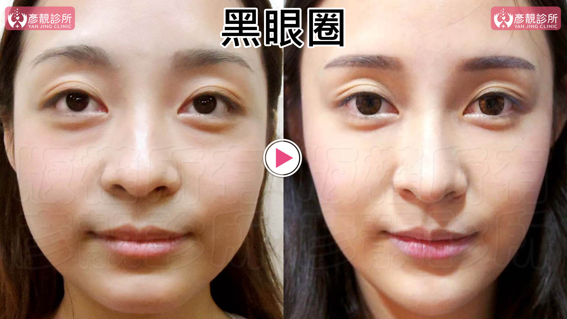 治療黑眼圈實際效果-正面