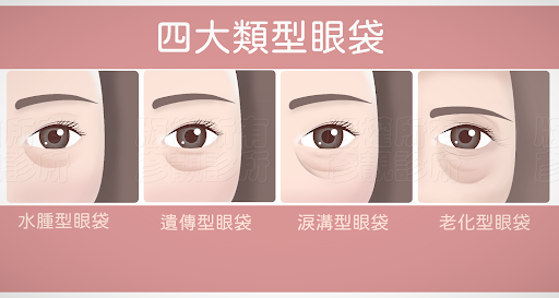 四大眼袋說明，圖文解說讓你一次了解眼袋形成原因