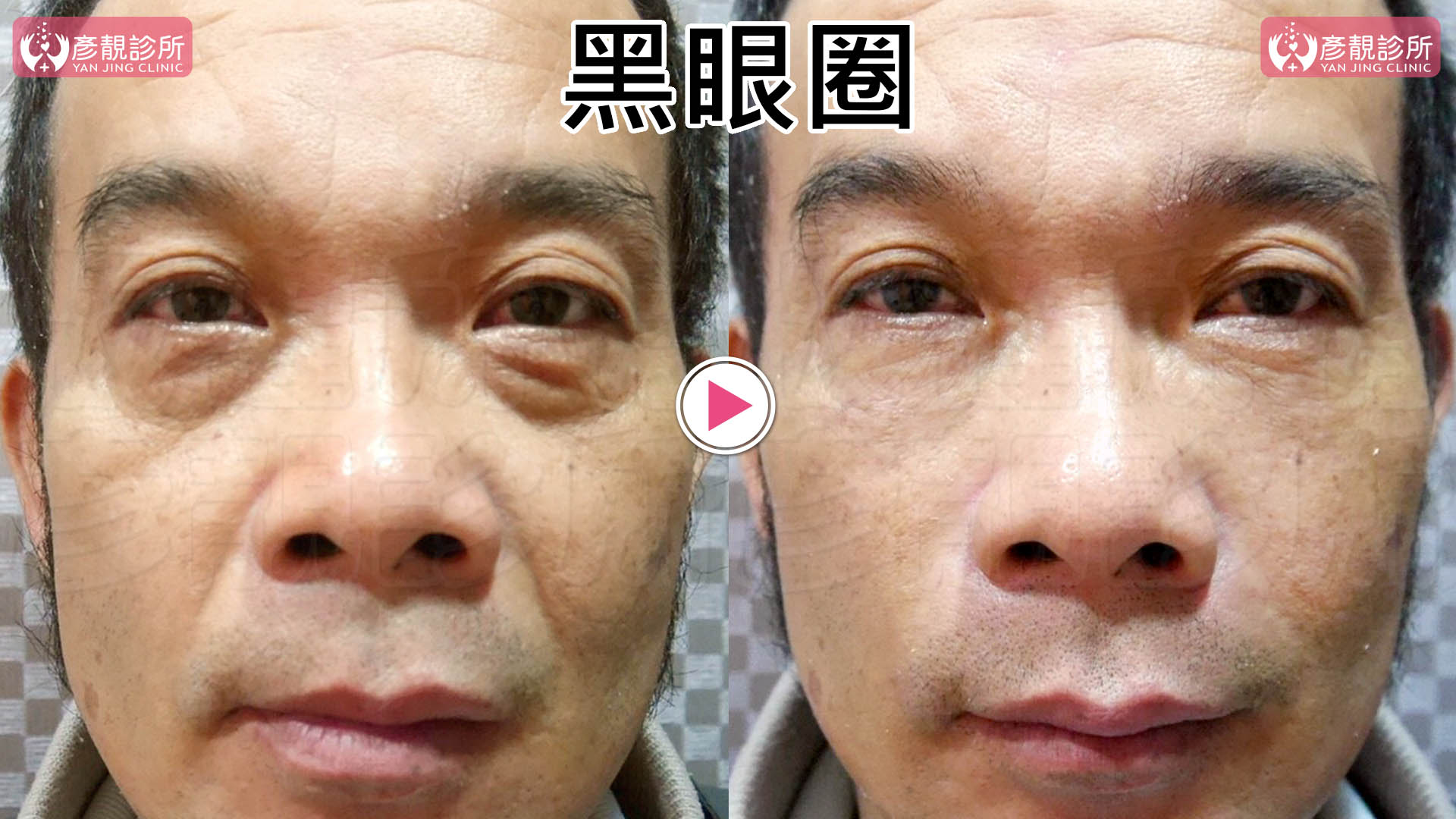 彥靚診所治療黑眼圈２大原因-黑眼圈淡化推薦玻尿酸雷射
