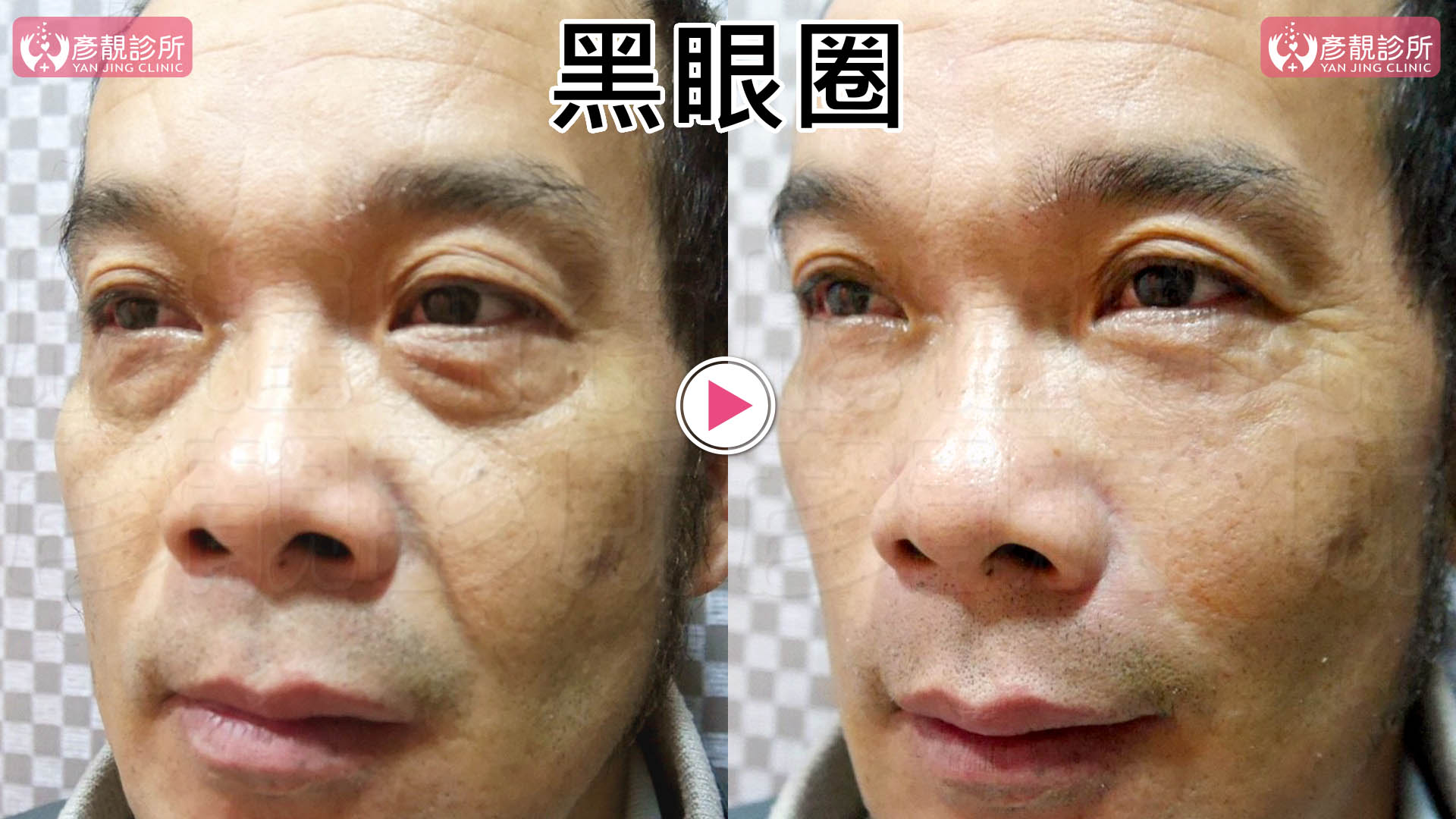 彥靚診所治療黑眼圈２大原因-黑眼圈淡化推薦玻尿酸雷射