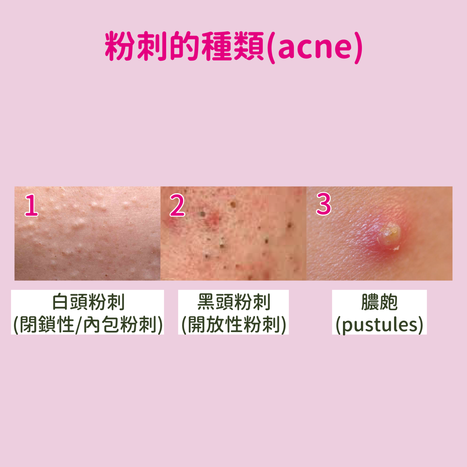 什麼是閉鎖性粉刺、白頭粉刺、黑頭粉刺?醫師教你如何清理粉刺與保養 - 彥靚診所 × 醫美.減重