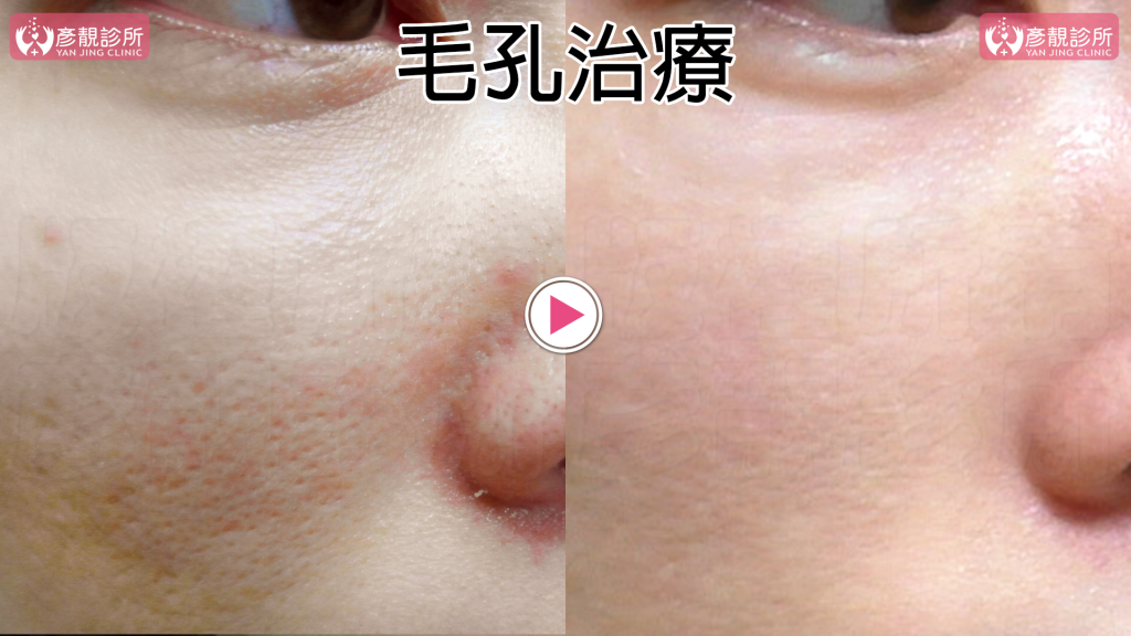 蜂巢皮秒-皮秒雷射毛孔粗糙肌膚治療術前術後照片分享