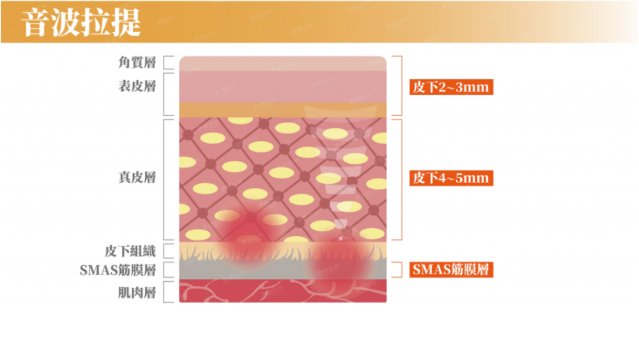 音波拉提聚焦皮膚深層組織筋膜層