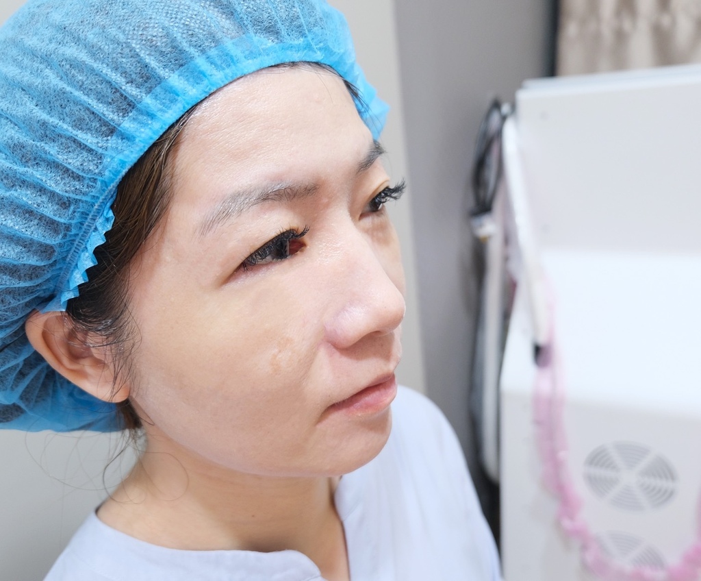 部落客打皮秒雷射斑點好膚質有感分享｜台北彥靚診所- 彥靚診所× 醫美．減重