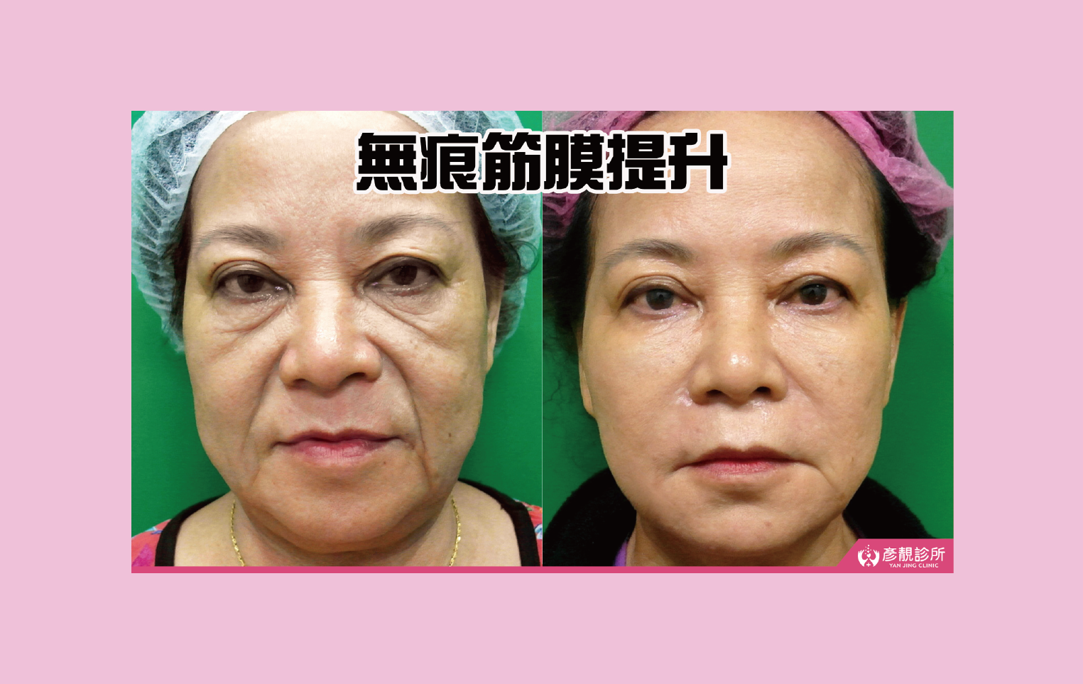 什麼是無痕筋膜提升？效果、維持時間、費用、台灣醫師推薦嗎？眾多案例分享- 彥靚診所× 醫美．減重