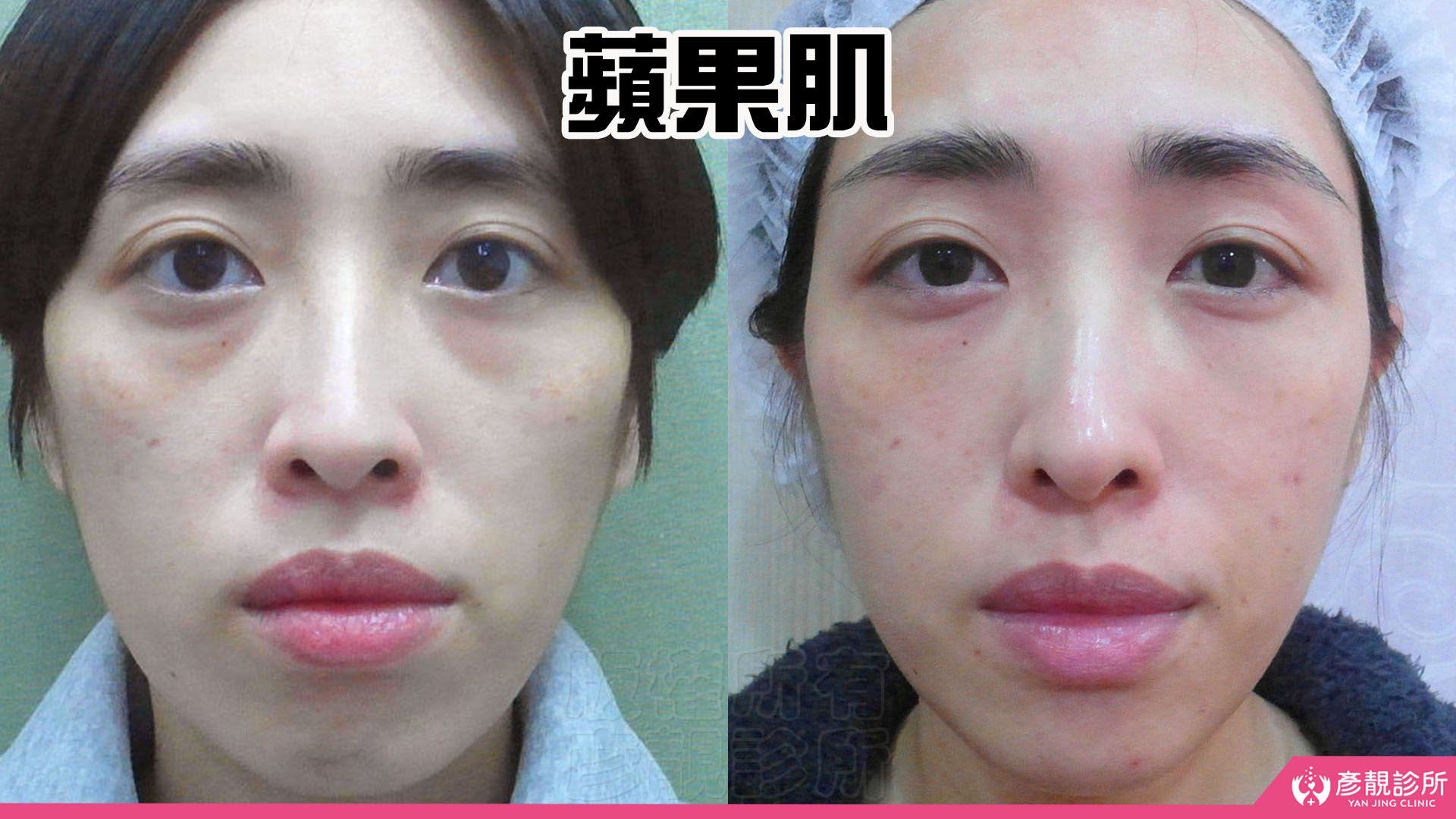 淚溝怎麼改善?先辨黑眼圈成因,再選適合的療程 16 女性淚溝合併中臉修飾的術前術後對照,左圖顴骨下方凹陷與臉頰轉折較明顯,右圖眼下至中臉銜接更平順,顴骨及上顎的突出感隨相鄰凹陷修飾而減輕,呈現由局部淚溝延伸至整體柔和線條的規劃。