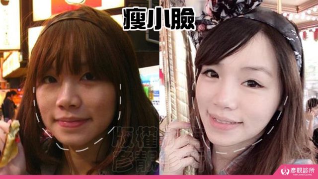 Dcard Botox Before and After Results10081 1024x576