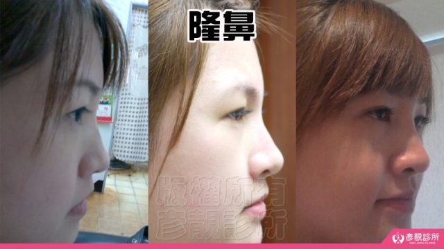 Fascial Lift Skin Sagging Facial Rejuvenation10031 1024x576