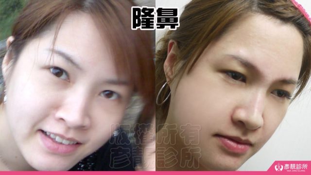 Fascial Lift Skin Sagging Facial Rejuvenation10032 1024x576
