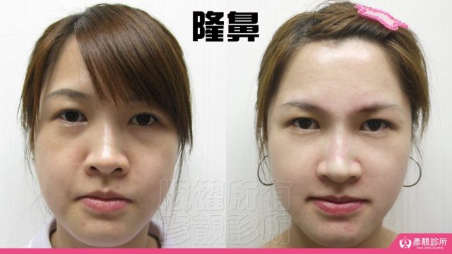 Fascial Lift Skin Sagging Facial Rejuvenation10033 1024x576