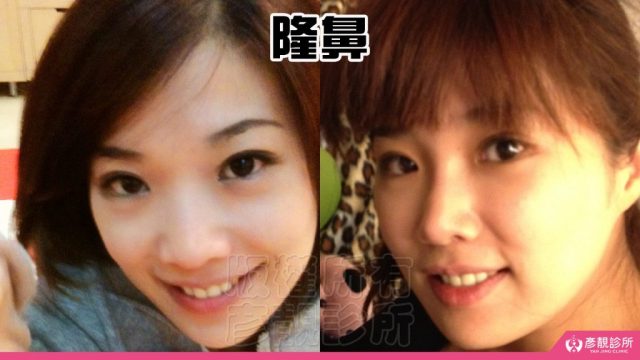 Hyaluronic Acid Nasolabial Folds Before and After10031 1024x576