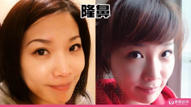 Hyaluronic Acid Nasolabial Folds Before and After10032 1024x576