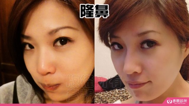 Hyaluronic Acid Nasolabial Folds Before and After10033 1024x576