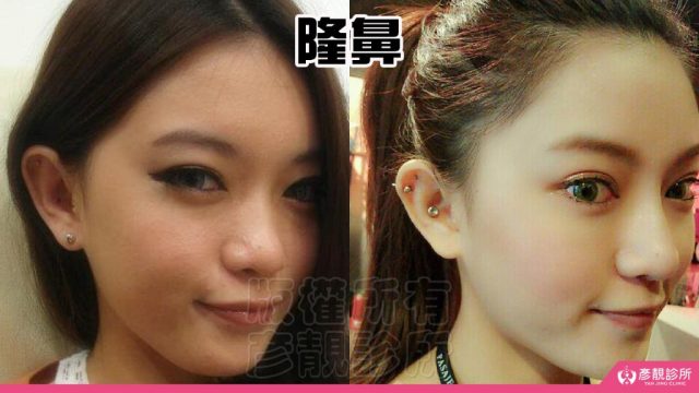 Hyaluronic Acid Tear Trough Under Eye Bags10036 1024x576