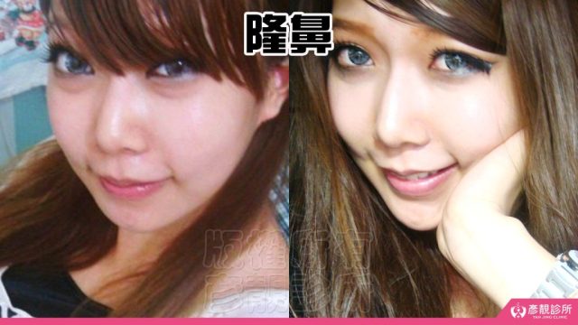 Jawline Enhancement Chin Augmentation Cost10081 1024x576
