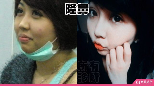 Skin Sagging Fascial Lift Facial Rejuvenation Results10034 1024x576