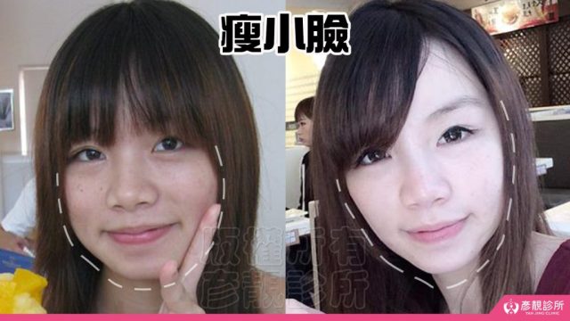Taipei Aesthetic Medicine Botox10081 1024x576