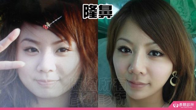 Under Eye Bags Tear Trough Dark Circle Injection Dark Circles10031 1024x576