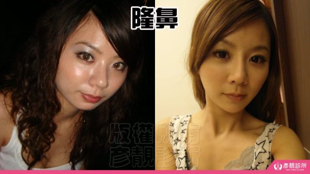 Under Eye Bags Tear Trough Dark Circle Injection Dark Circles10032 1024x576