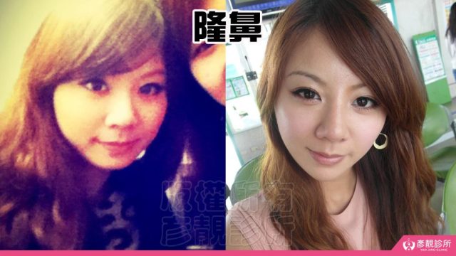 Under Eye Bags Tear Trough Dark Circle Injection Dark Circles10033 1024x576