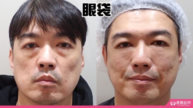 淚溝-眼袋-黑眼圈-失敗-玻尿酸-手術-推薦-幼態臉-3D無痕筋膜提升-消除改善-價格費用-台北-桃園-新竹-術後保養-評價-彥靚-診所-醫師-醫生-副作用併發症後遺症-心得-分享-dcard-ptt-32