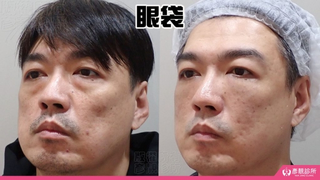 淚溝-眼袋-黑眼圈-失敗-玻尿酸-手術-推薦-幼態臉-3D無痕筋膜提升-消除改善-價格費用-台北-桃園-新竹-術後保養-評價-彥靚-診所-醫師-醫生-副作用併發症後遺症-心得-分享-dcard-ptt-36