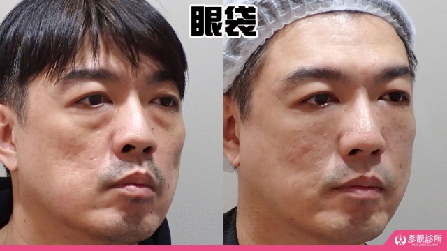 淚溝-眼袋-黑眼圈-失敗-玻尿酸-手術-推薦-幼態臉-3D無痕筋膜提升-消除改善-價格費用-台北-桃園-新竹-術後保養-評價-彥靚-診所-醫師-醫生-副作用併發症後遺症-心得-分享-dcard-ptt-37