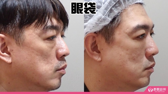 淚溝-眼袋-黑眼圈-失敗-玻尿酸-手術-推薦-幼態臉-3D無痕筋膜提升-消除改善-價格費用-台北-桃園-新竹-術後保養-評價-彥靚-診所-醫師-醫生-副作用併發症後遺症-心得-分享-dcard-ptt-39