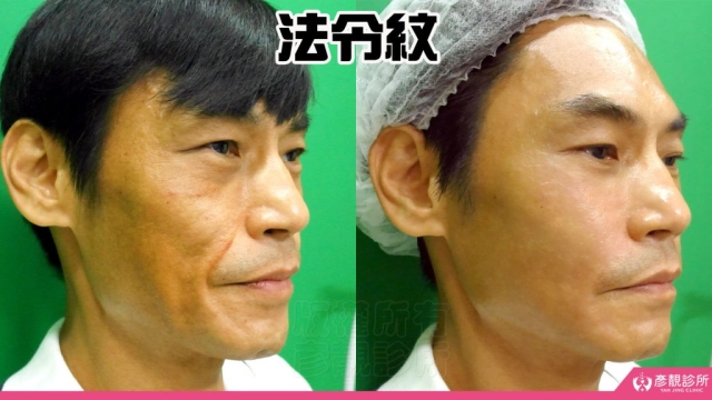 法令紋-失敗-木偶紋-嘴邊肉-玻尿酸- 拉皮-推薦-幼態臉-3D無痕筋膜提升-黃政達-台北-桃園-新竹-術後保養-評價-彥靚-診所-醫師-醫生-心得-分享-ptt-dcard-04
