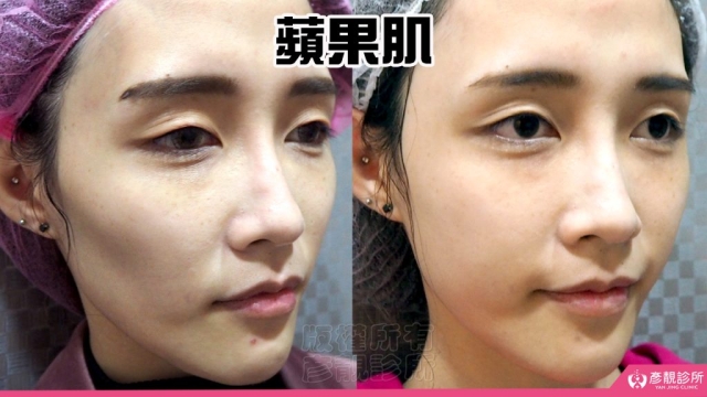 蘋果肌 蘋果肌-豐頰-下垂-凹陷-玻尿酸-嬰兒肥-幼態臉-3D無痕筋膜提升-推薦-醫生-效果-彥靚-診所-114081101