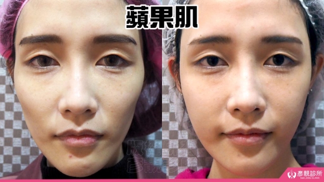 蘋果肌 蘋果肌-豐頰-下垂-凹陷-玻尿酸-嬰兒肥-幼態臉-3D無痕筋膜提升-推薦-醫生-效果-彥靚-診所-114081102
