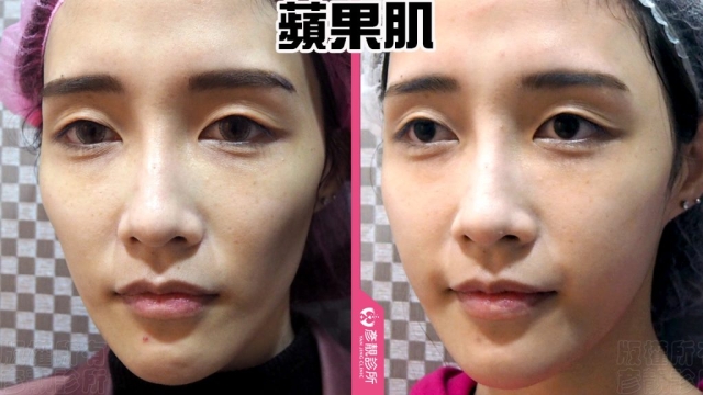 蘋果肌 蘋果肌-豐頰-下垂-凹陷-玻尿酸-嬰兒肥-幼態臉-3D無痕筋膜提升-推薦-醫生-效果-彥靚-診所-114081105