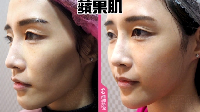 蘋果肌 蘋果肌-豐頰-下垂-凹陷-玻尿酸-嬰兒肥-幼態臉-3D無痕筋膜提升-推薦-醫生-效果-彥靚-診所-114081106