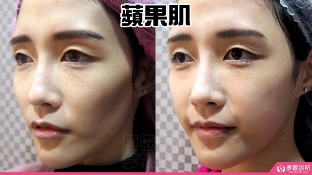 蘋果肌 蘋果肌-豐頰-下垂-凹陷-玻尿酸-嬰兒肥-幼態臉-3D無痕筋膜提升-推薦-醫生-效果-彥靚-診所-114081107